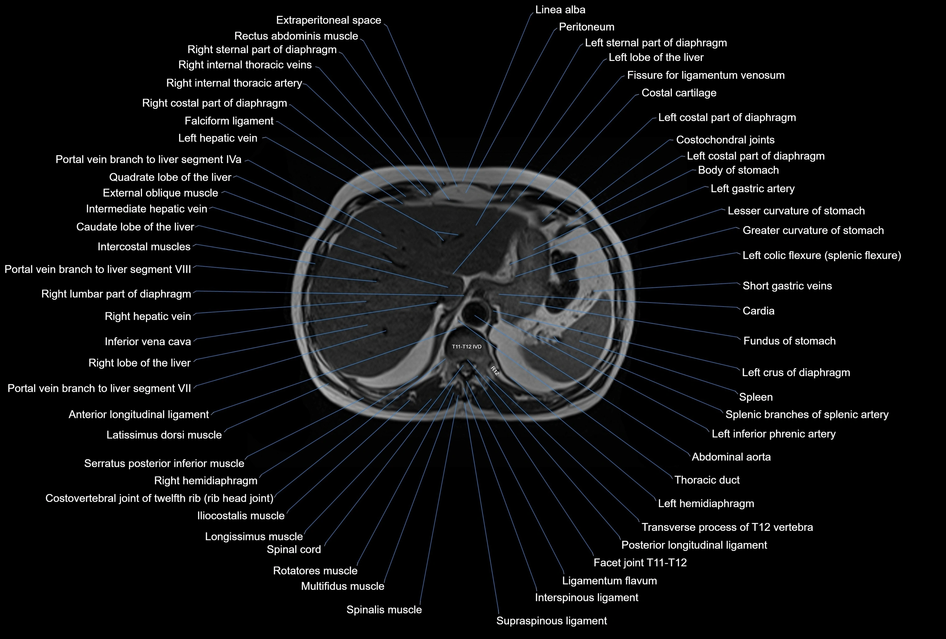 MRI Abdomen axial cross sectional anatomy radiology  image-img-00001-00010.webp